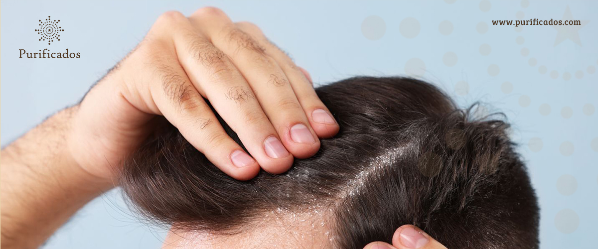 How Argan Oil Helps Combat Dandruff